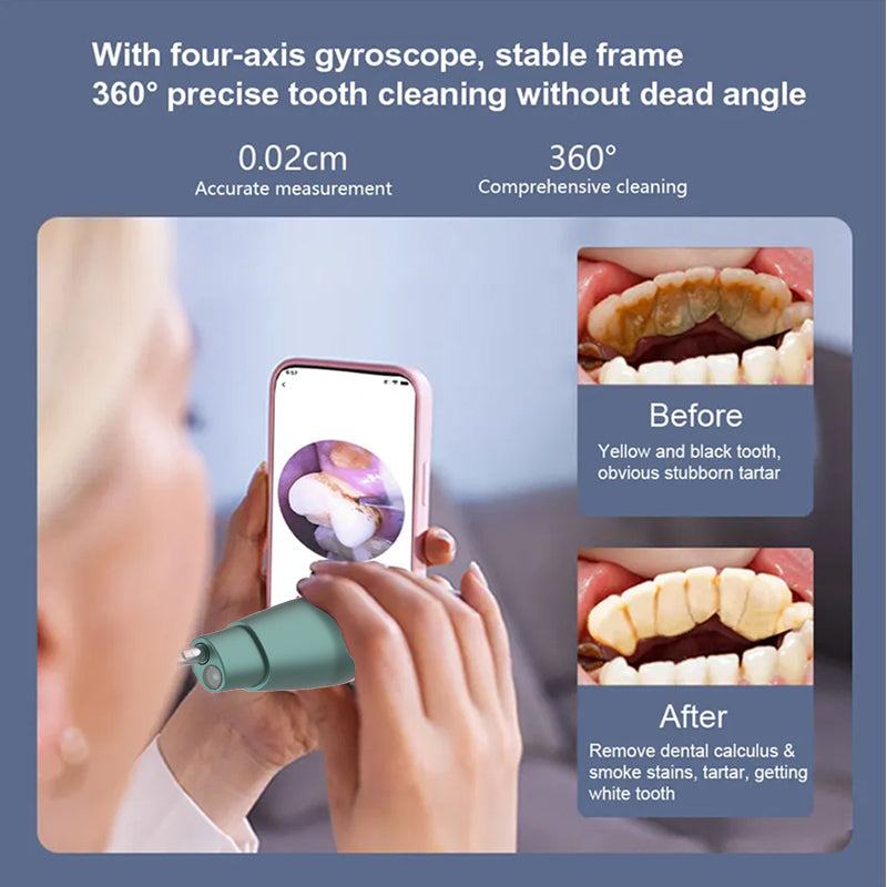 Smart HD Visual Ultrasonic Dental Scaler – 1080P WiFi Camera & Tartar Plaque Remover with 316 Stainless Steel Tips